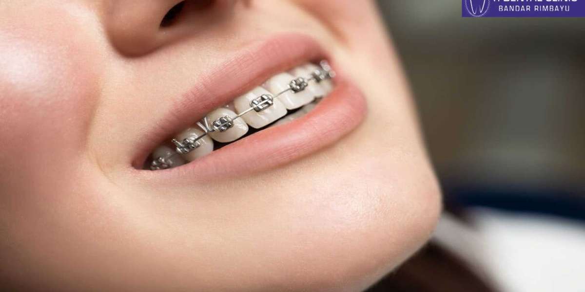 Teeth Veneers: Elevating Your Smile, Boosting Your Confidence
