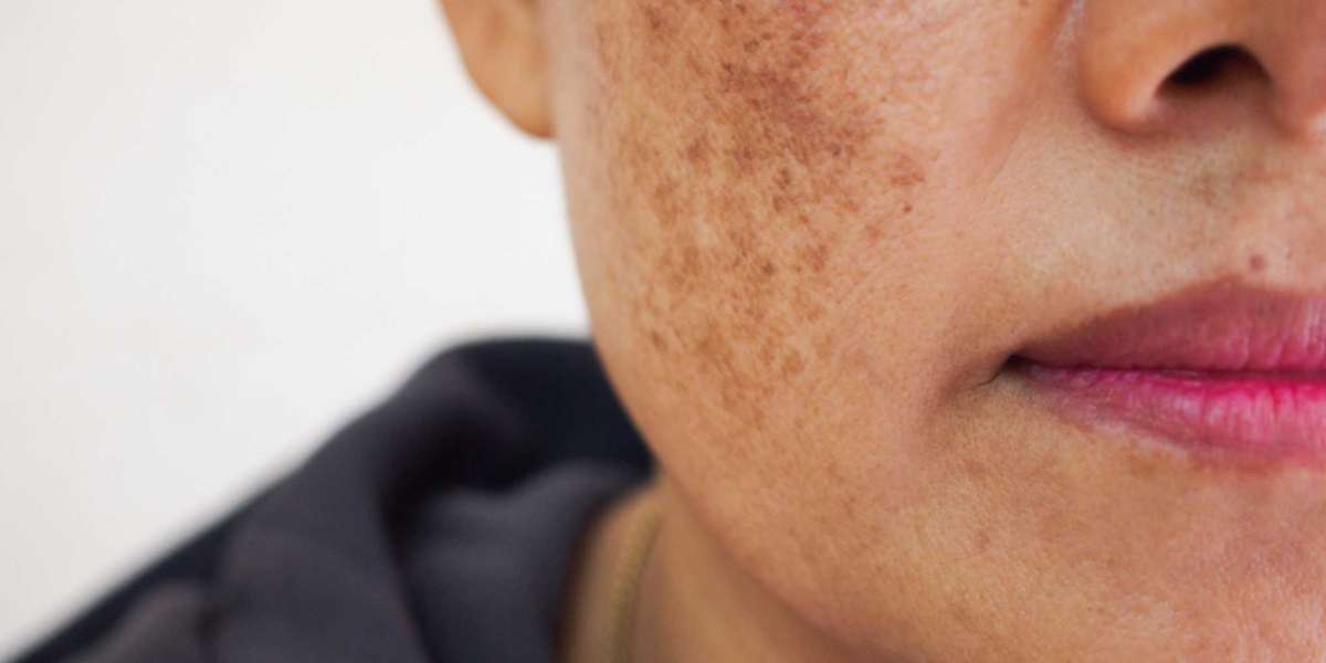Hyperpigmentation Disorder Treatment Market  Overview, Scope, Trends and Industry Research Report 2031