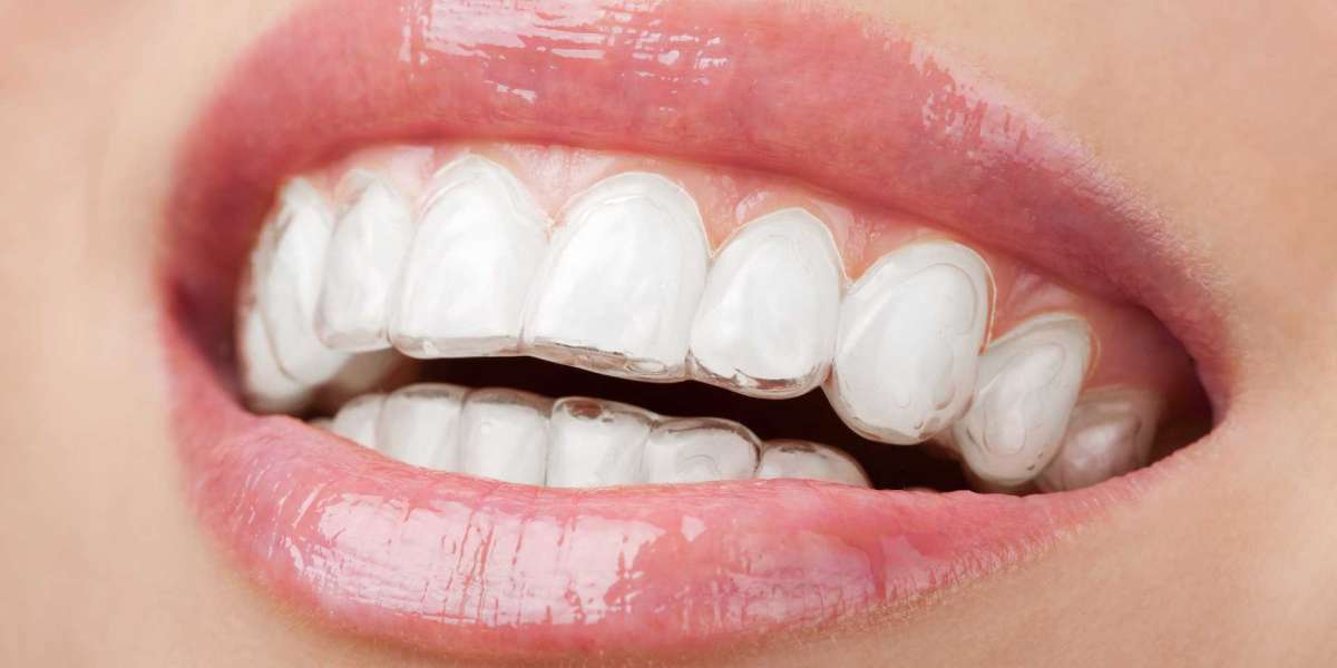 Understanding Invisalign Teeth: A Comprehensive Guide