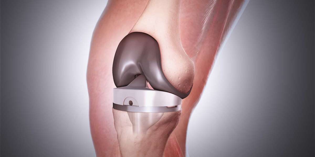 Knee Cartilage Replacement Market Size, Key Players, Top Regions, Growth and Forecast by 2031