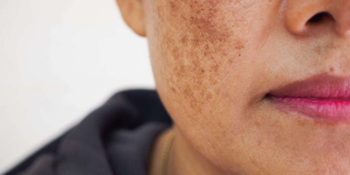 Hyperpigmentation Disorder Treatment Market By Application, Drive Mechanism and Region Forecasts to 2030