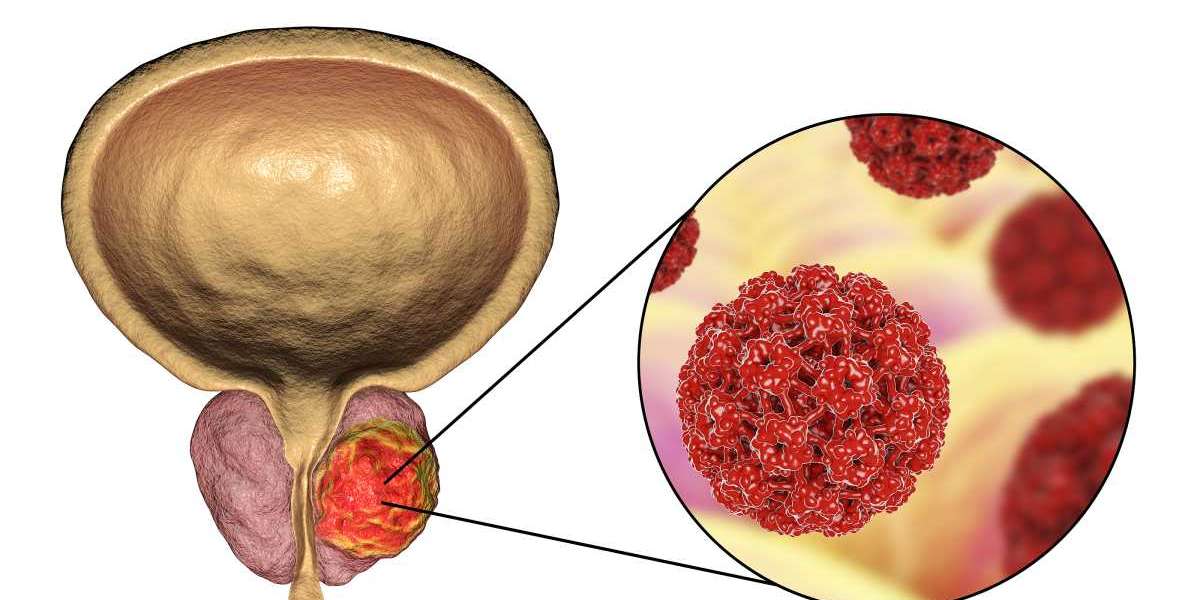 Prostate Cancer Diagnostics Market Solutions and Services to 2031