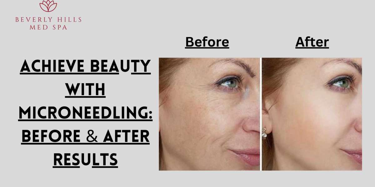 Achieve Beauty with Microneedling: Before & After Results